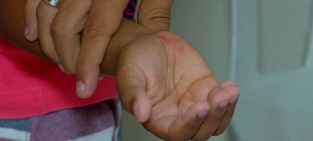 Criança de sete anos é atacada por raposa na zona rural de Caxias